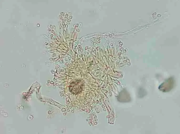 Hyalohyphomycosis is infection due to nonpigmented (hyaline) septate fungi that form hyphal elements in tissue
